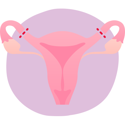 Illustration showing simplified diagram of tubal litigation